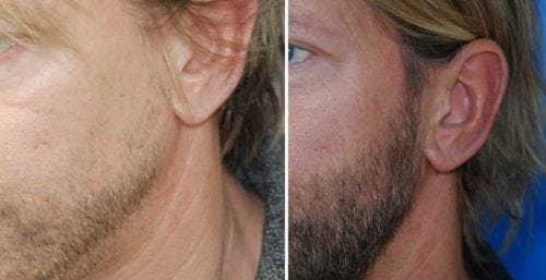 BeardHairTransplantLft
