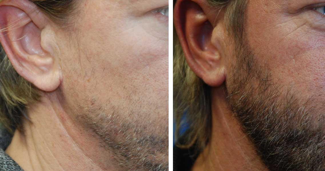 BeardHairTransplantRt