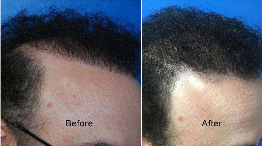Before photo is of patient with old plug style hair line and the after is 1 year after FUE hair transplantation of back hair to soften and expand the hairline.