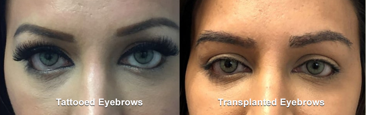 Eyebrow-H-air-Transplant