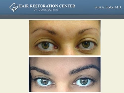 Eyebrow hair transplant