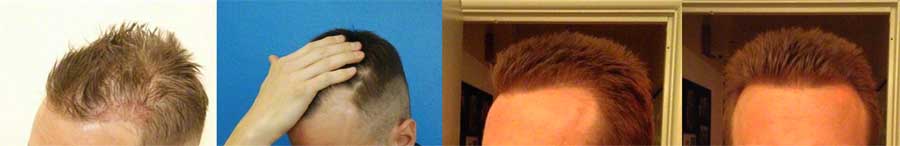 Images provided by patient. The two left images are before and the two right images are 10 months post-op 800 FUE hair grafts,