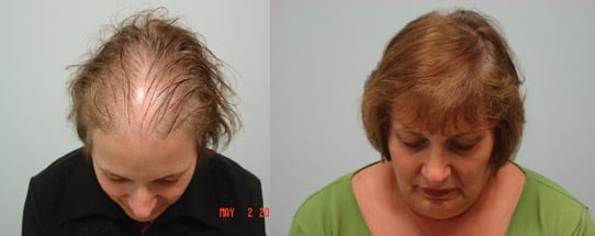 Female Hair Transplant