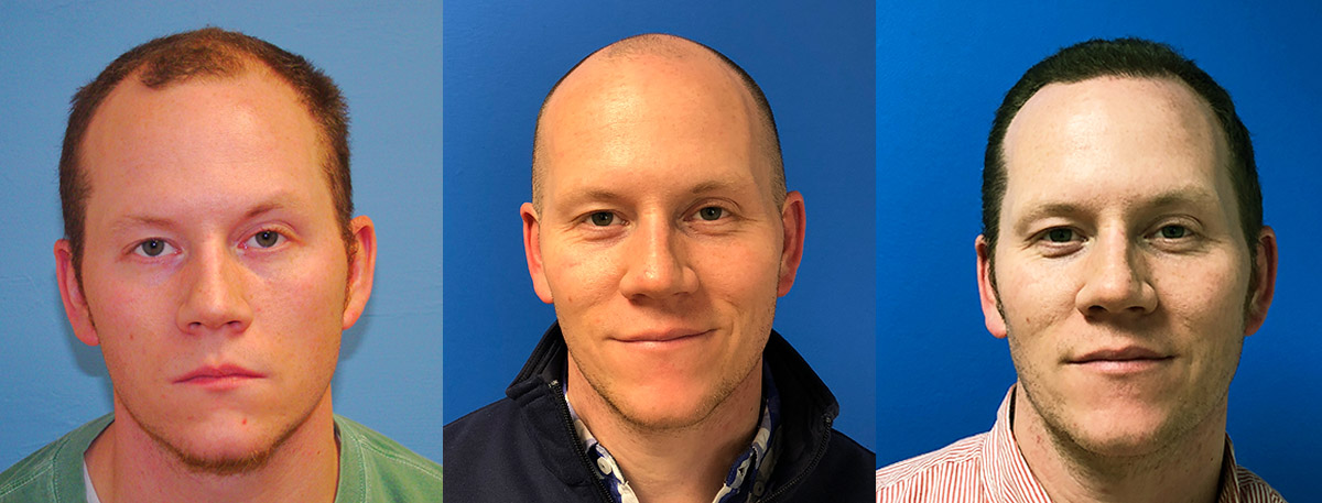 Front3Shot (L-R) 6 Years prior, Immediately pre-op with shaved head and 8 months post -op