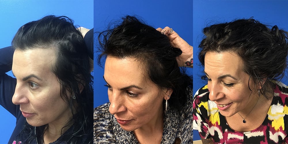 Transgender hair transplant
