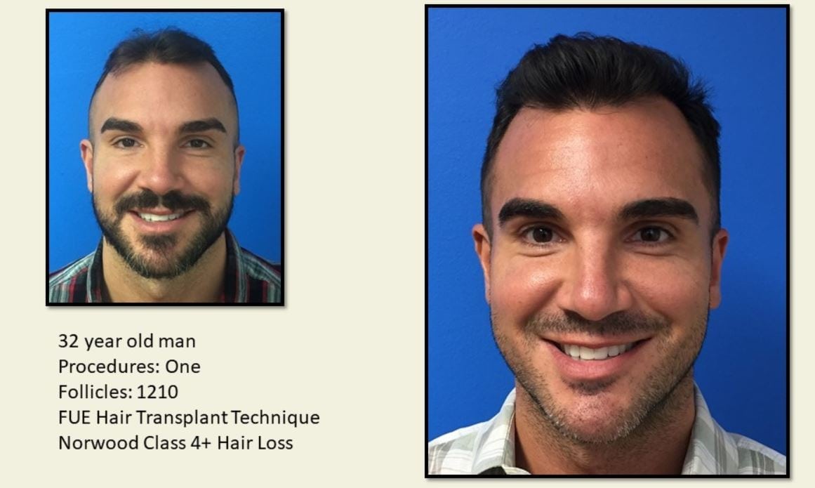 MattBA Excellent Hair Transplant Result
