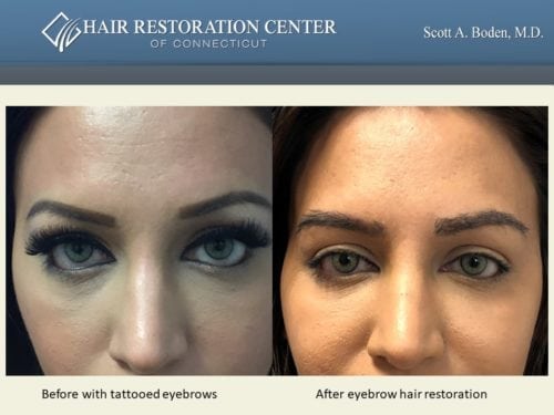 Eyebrow hair transplant