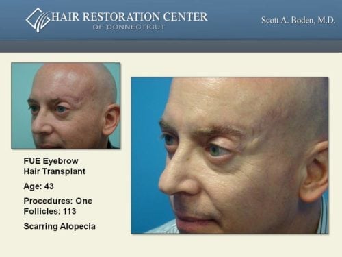 Eyebrow hair transplant