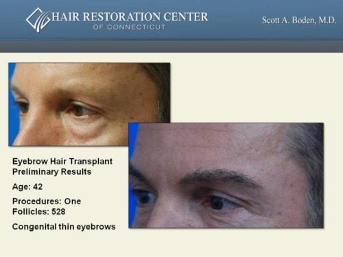 Eyebrow hair transplant