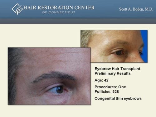 Eyebrow hair transplant