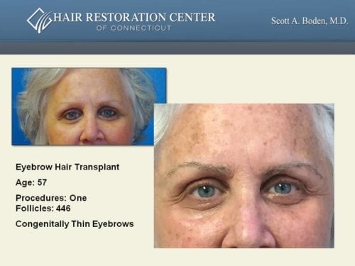 Eyebrow hair transplant