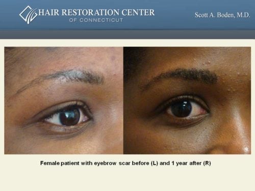 Eyebrow hair transplant