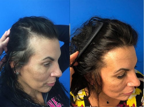 Transgender hair transplant